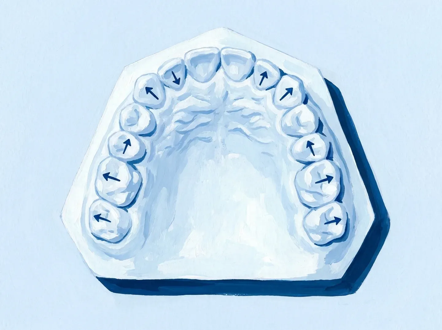 Un modelo de arcada con pequeñas flechas sobre algunos dientes, marcando hacia dónde se mueve cada uno