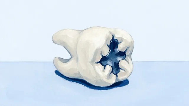 Un molar de escayola con un empaste metálico oscuro en su cara de masticar