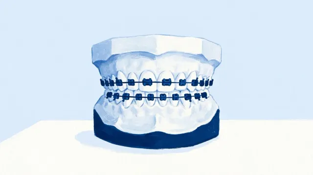 Un modelo con los brackets pegados y el arco pasando por todos ellos