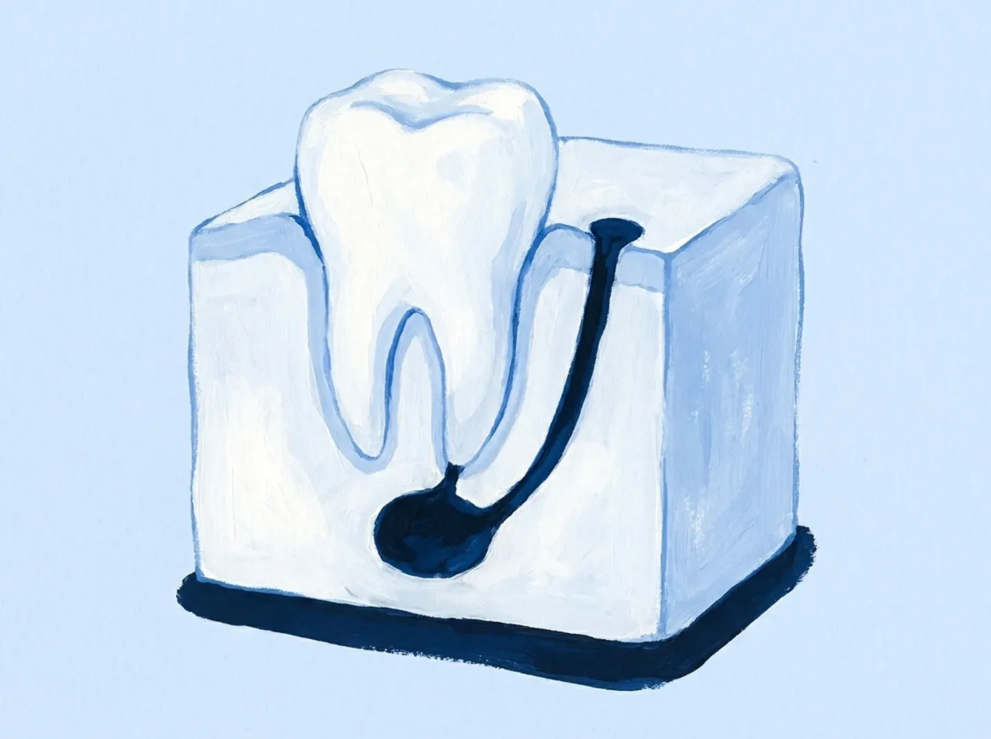 Un molar dentro de un bloque de hueso cortado, con una bolsa bajo la raíz y un canal que sube