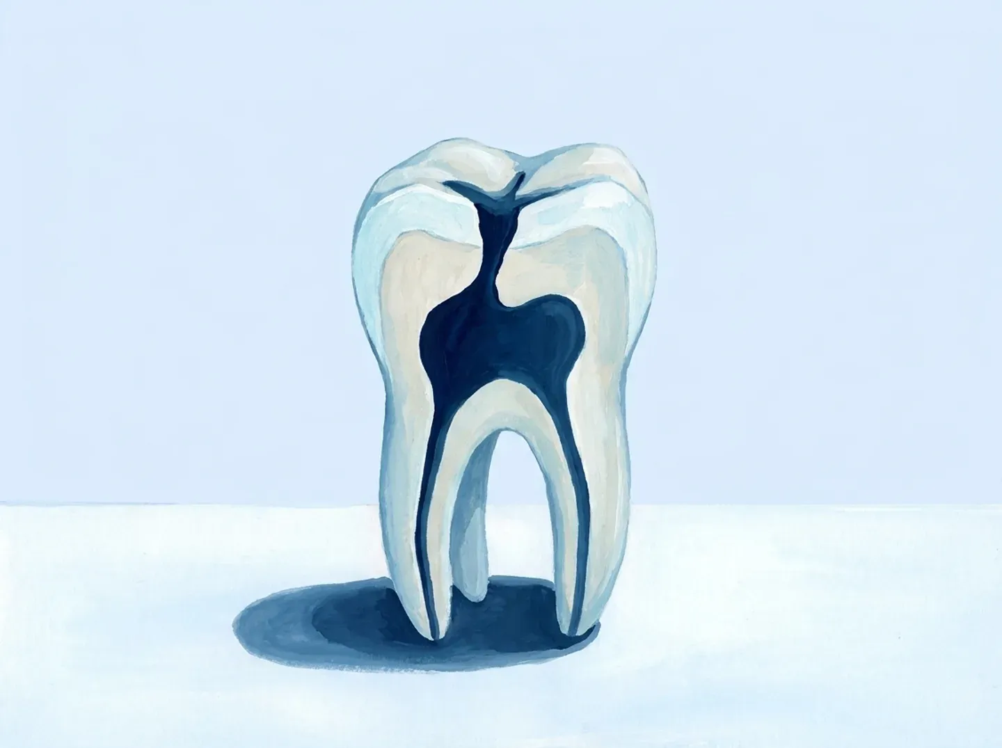 El mismo molar cortado: la caries entra estrecha y se ensancha por dentro