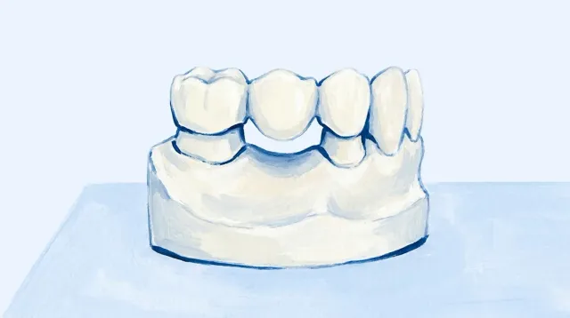 Un puente de tres piezas encajado sobre el modelo, con los dos dientes que lo sujetan