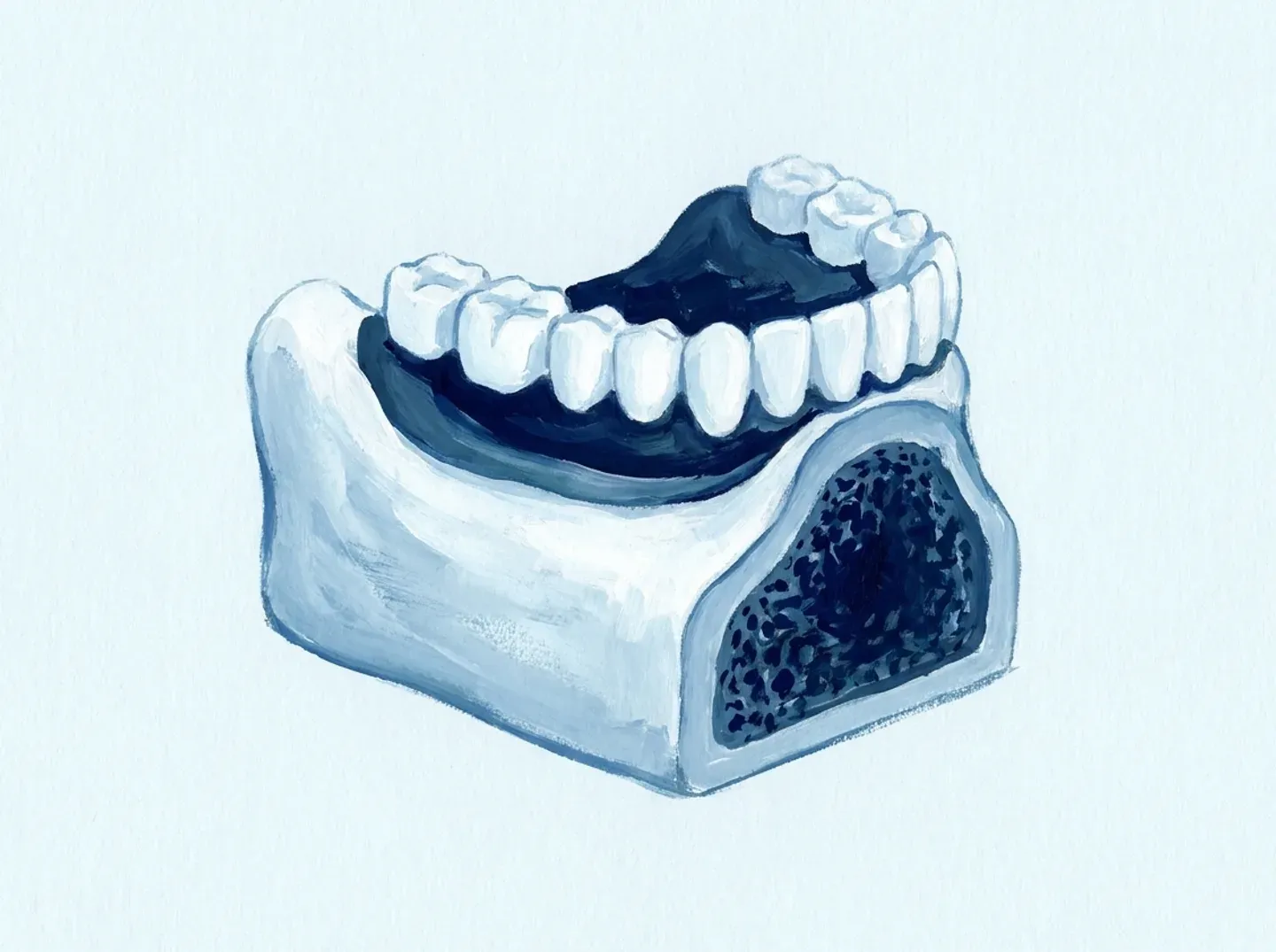 Un corte de hueso con la cresta gastada y la dentadura apoyada encima, sin agarre