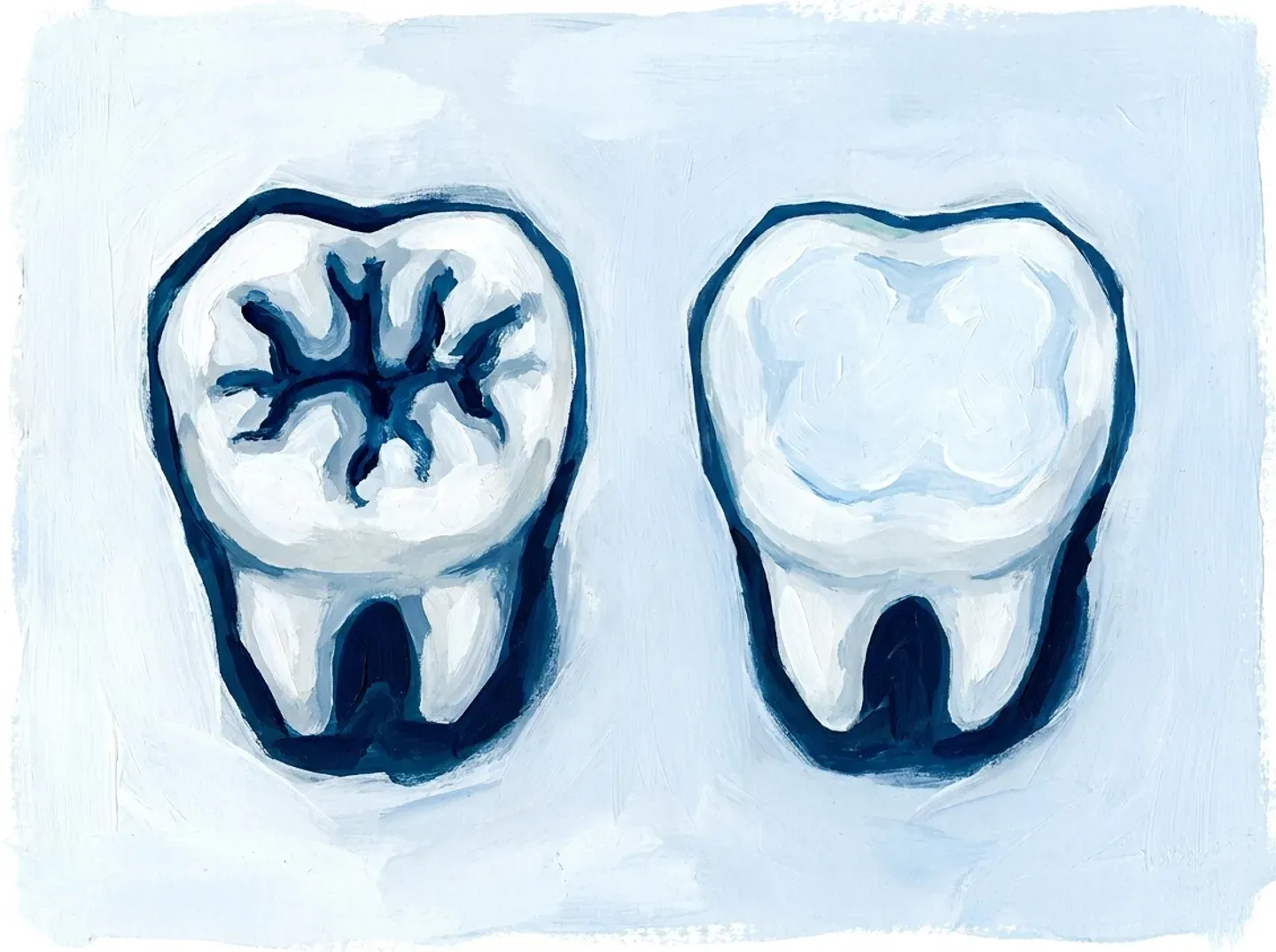 Un molar recién salido con los surcos hondos, y otro con esos surcos ya sellados