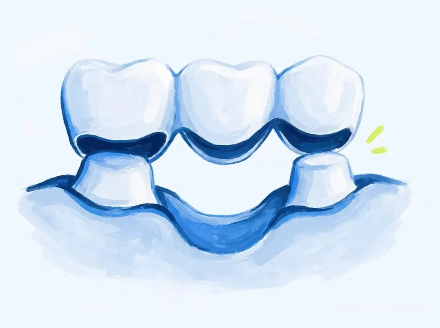 Un puente dental con el tramo central flotando y el hueso hundido por debajo