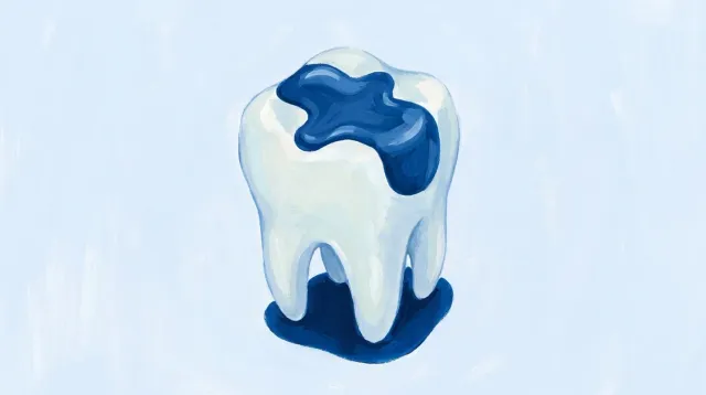 Un molar recién empastado, con el empaste ocupando buena parte de la cara de masticar
