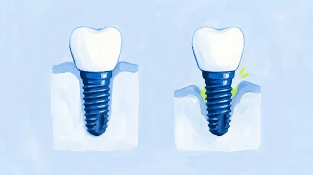 Dos implantes: uno con el hueso entero alrededor y otro con el hueso retirado y el metal a la vista