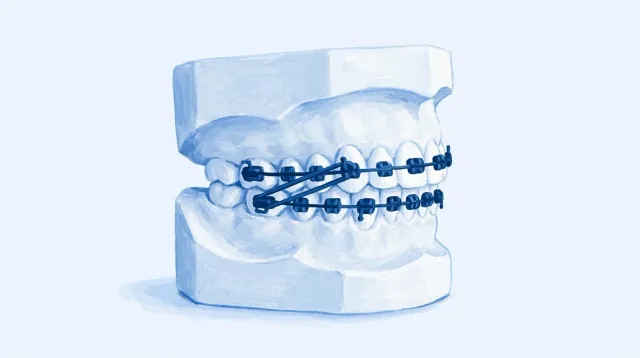 Un modelo con brackets visto de lado y dos gomas tendidas en direcciones distintas