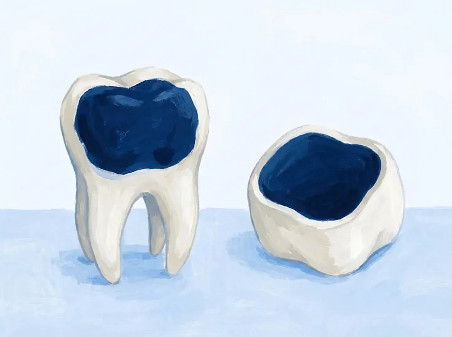 Un molar con el empaste ocupándolo casi entero, y al lado una corona entera