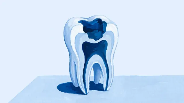 Un molar cortado con una caries y el tramo de diente sano que queda entre ella y el nervio