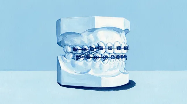Un modelo con brackets y una goma elástica enganchada entre la arcada de arriba y la de abajo