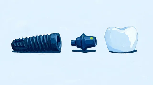 Las tres piezas de un implante separadas sobre una mesa: el tornillo, el pilar y la corona