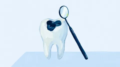 Una muela de escayola con una cavidad marcada en la superficie, junto a un espejo dental.