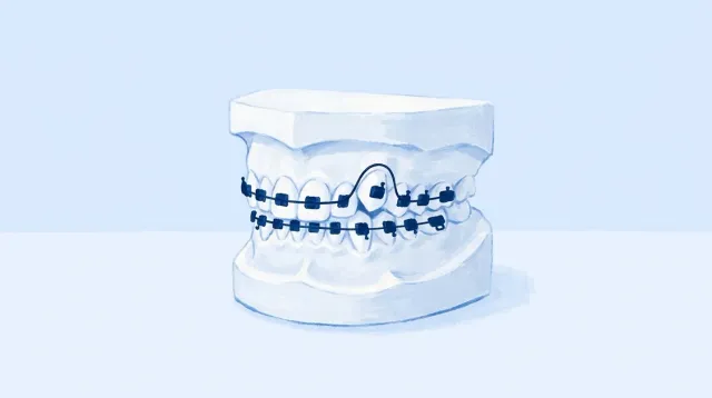 Un modelo con los dientes montados y un arco tenso pasando por delante de todos