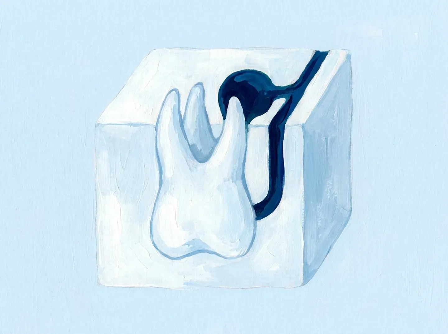 Un molar de lado con la raíz hacia arriba y una bolsa que asoma por el techo