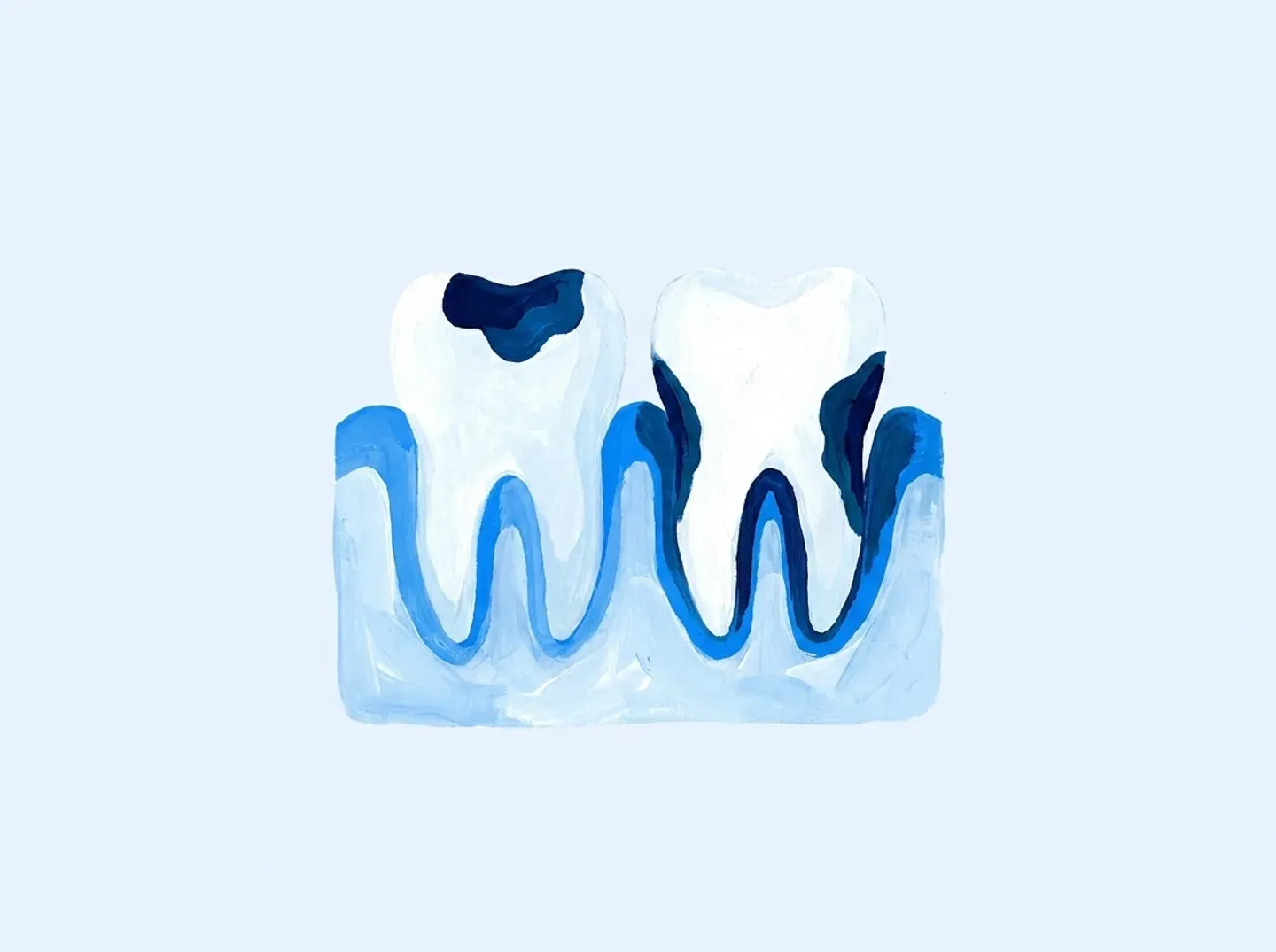 Un corte con dos focos marcados: una caries en un diente y una bolsa junto a otro