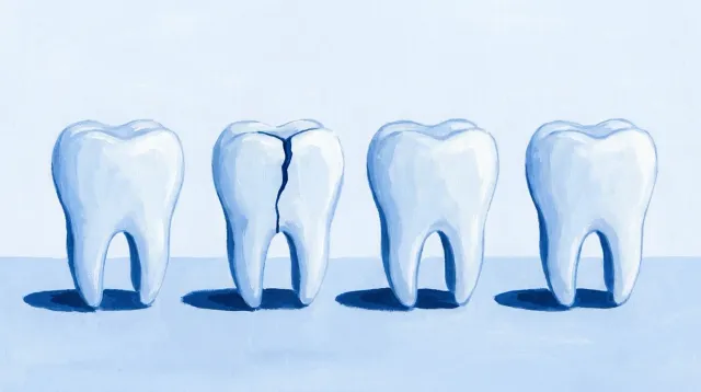 Una fila de dientes iguales con una fisura fina que baja por uno solo de ellos