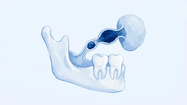 Un corte de la mandíbula con la glándula salival debajo y su conducto, con una piedrecita atascada