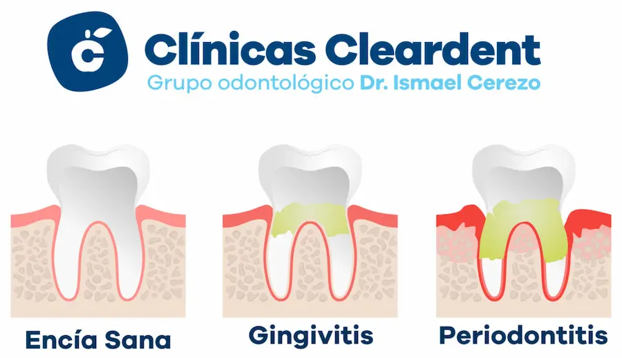 Grados de Enfermedad Periodontal Cleardent