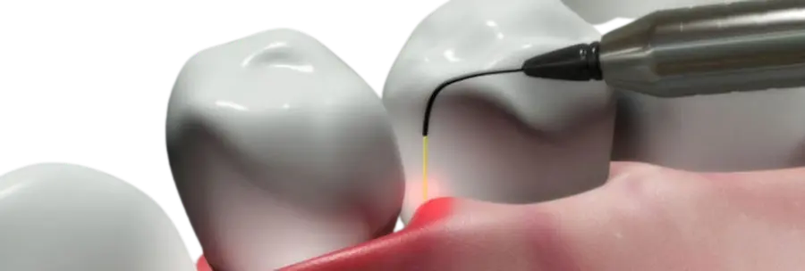 laser periodontal Cleardent