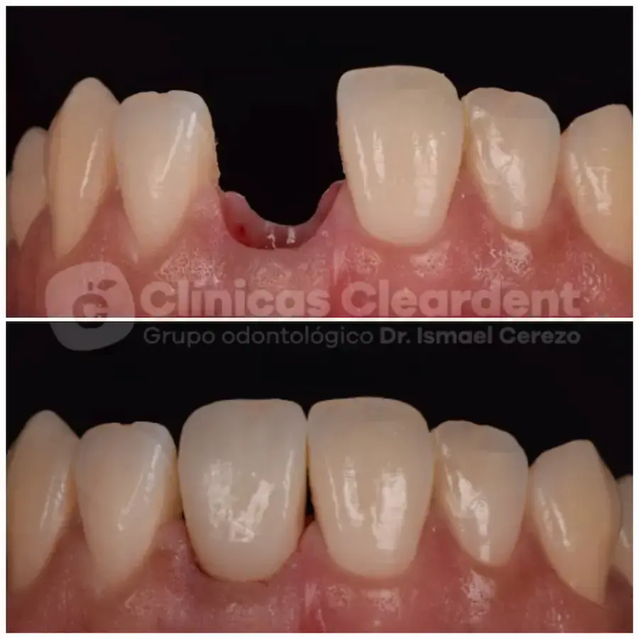 Evitar complicaciones en tratamientos de Implantes Dentales, cleardent