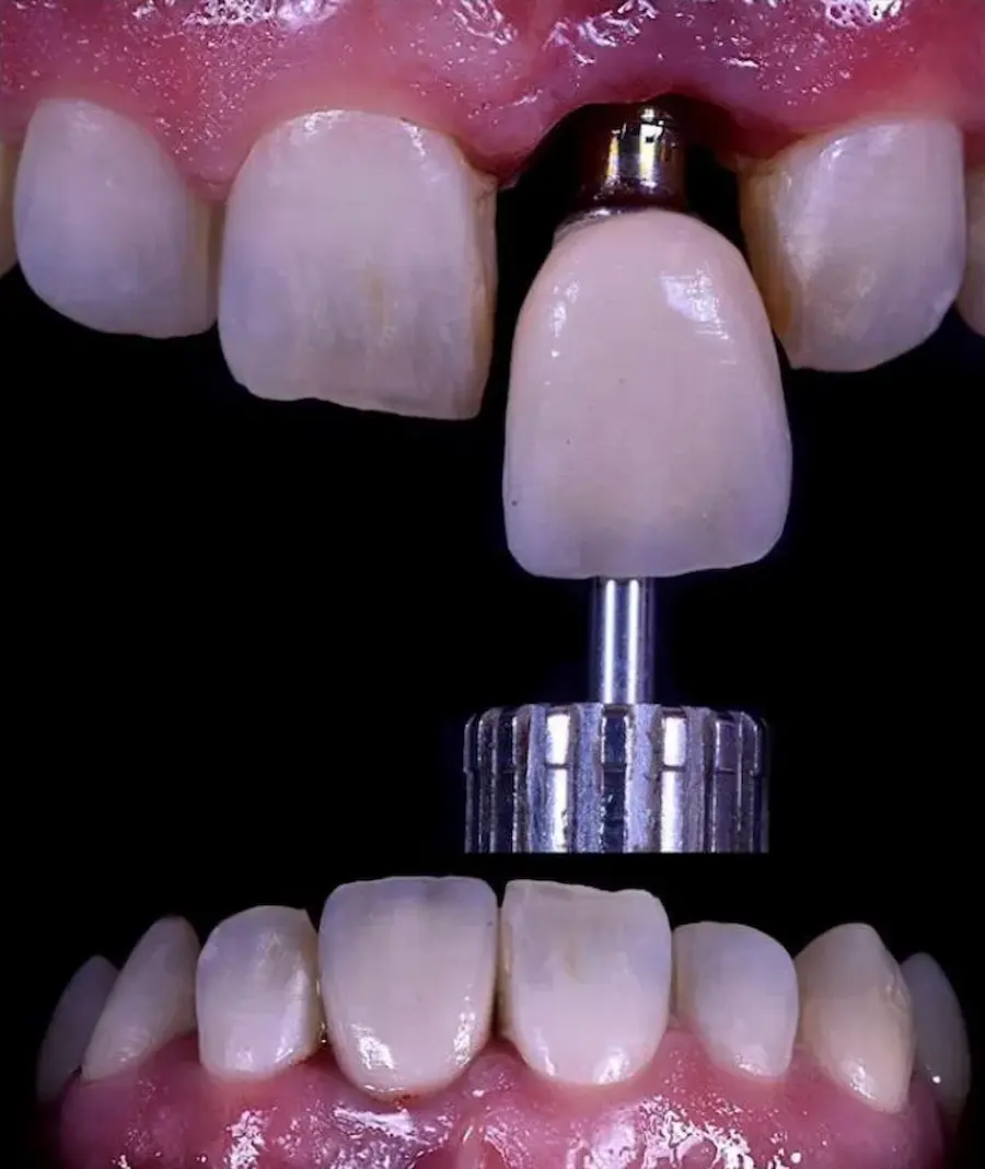 Soluciones ante la falta de dientes, cleardent