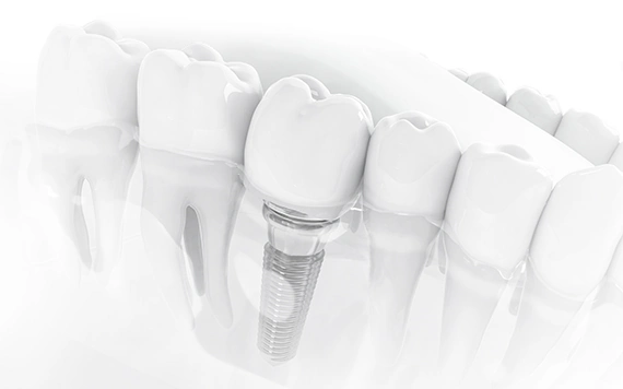 implante dental ejemplo