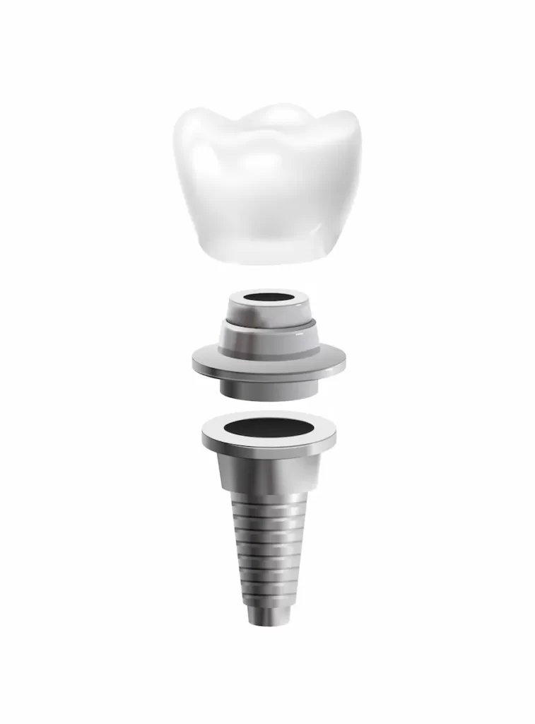 implante dental partes, cleardent