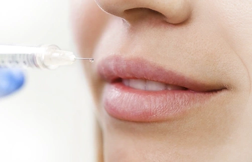 labios con acido hialuronico