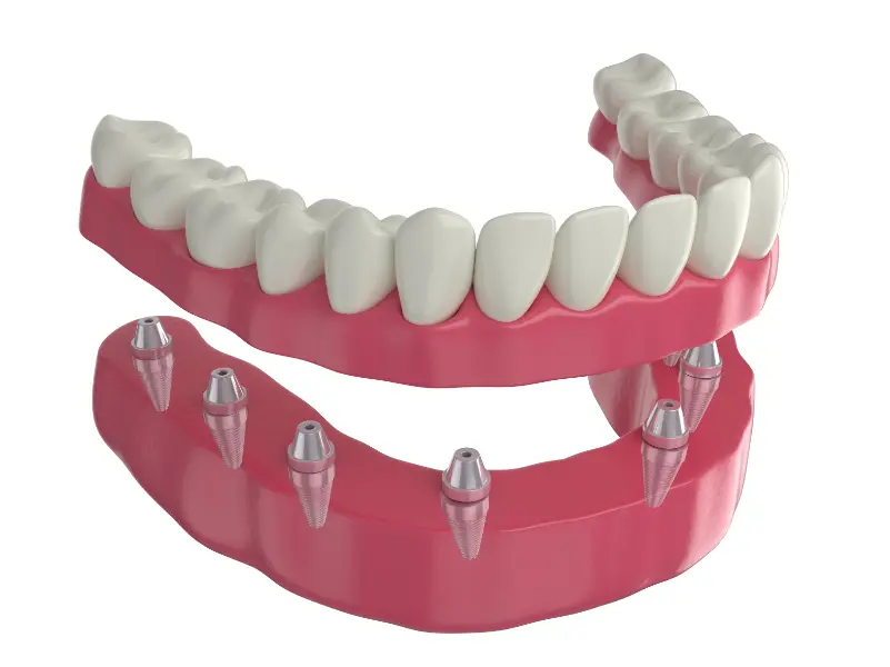 Prótesis dental Clínicas Cleardent