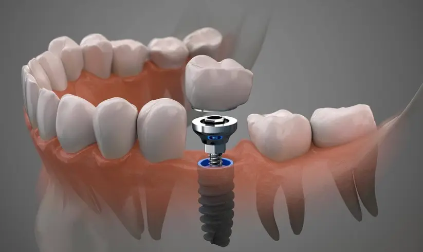cicatrización implantes