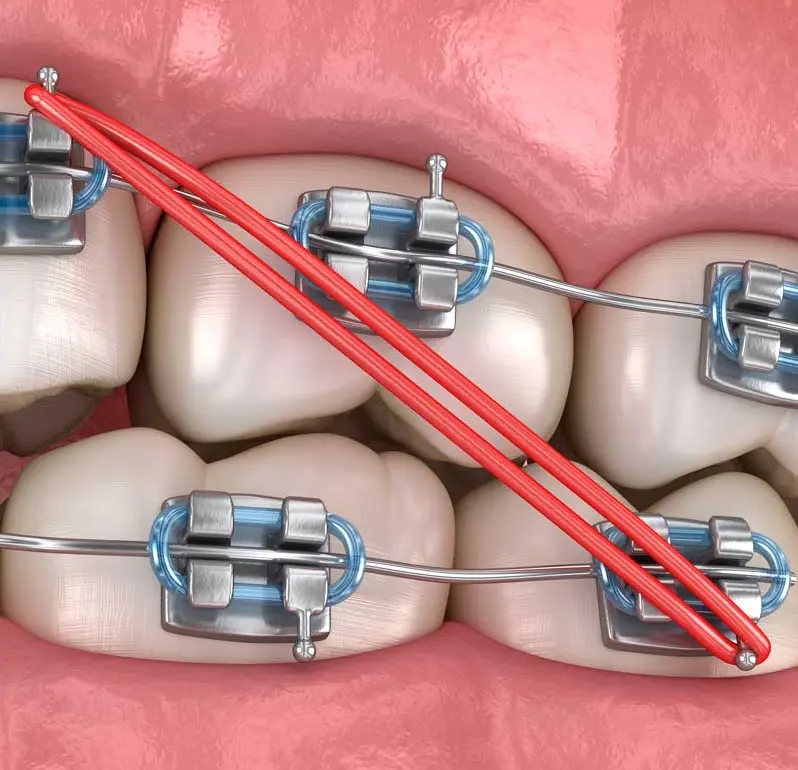 elasticos intermaxilares
