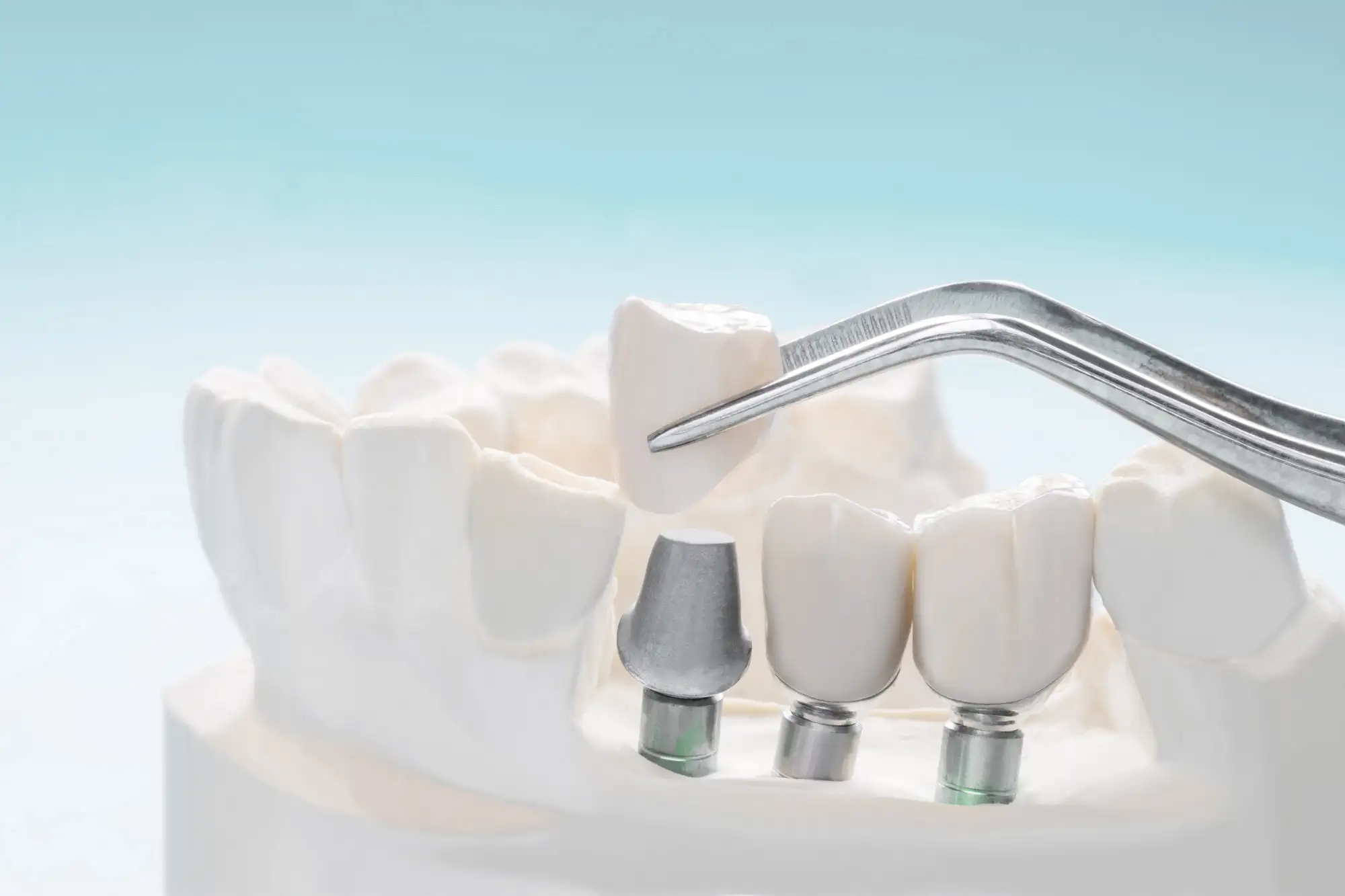 implante dental con poco hueso