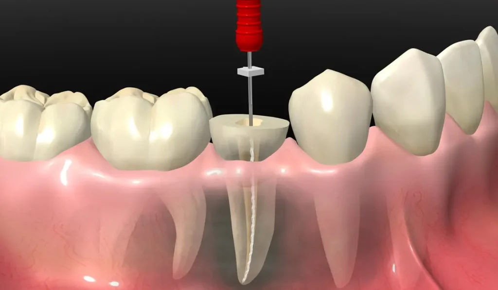 procedimiento de endodoncia