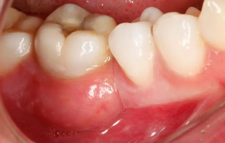 absceso dental