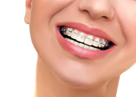 brackets autoligables