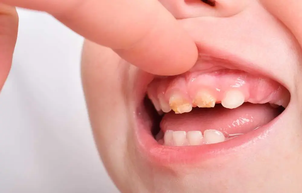 caries rampante