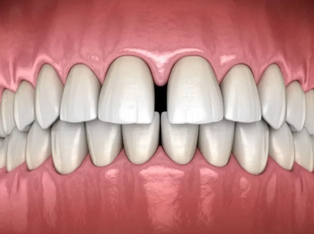 diastema provocado por frenillo