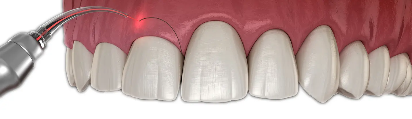 gingivectomia