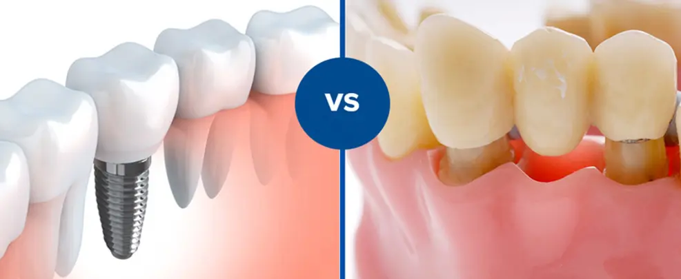 puente dental vs implante