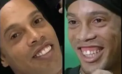 ronaldinho sonrisa gingival