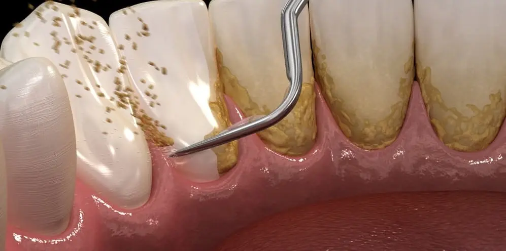 sarro dental en dientes