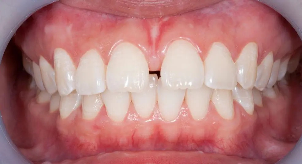 tronera dental