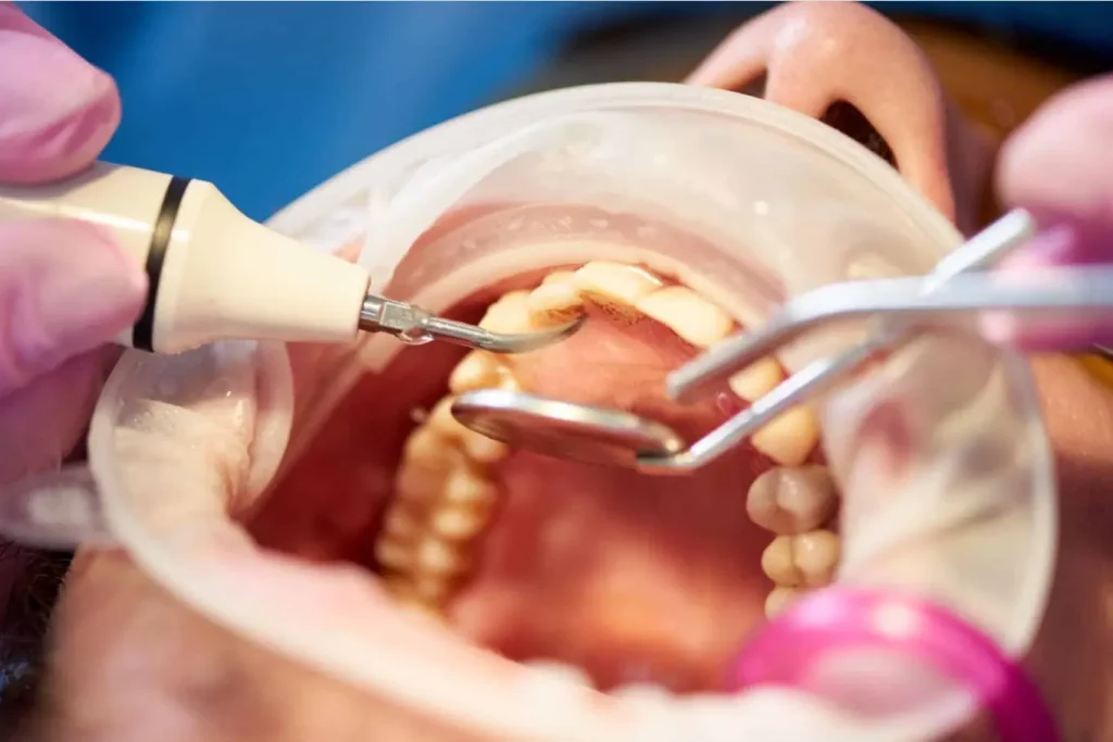 Sarro Subgingival
