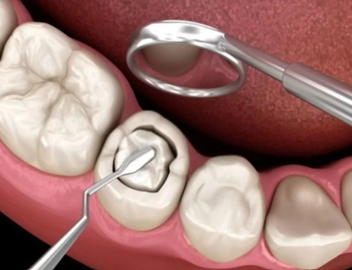 colocación de amalgama