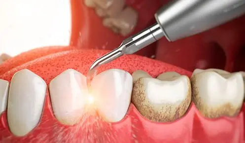 sarro supragingival