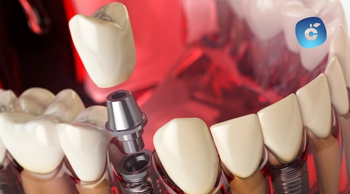 Corona dental