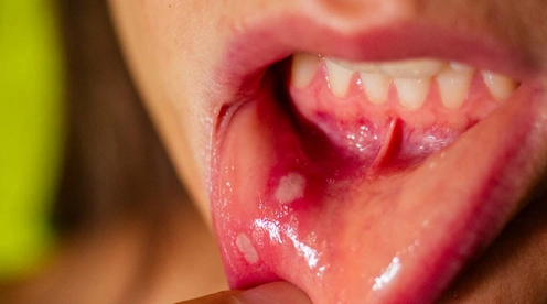 Llagas en la boca