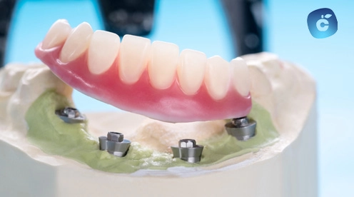 dentadura fija sobre 4 implantes