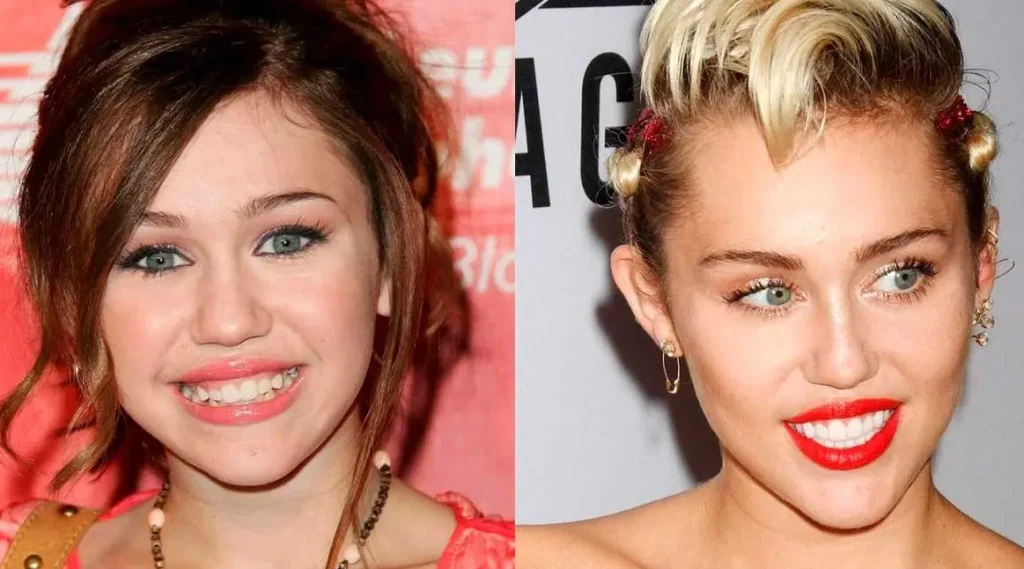 famosa carillas dentales